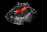 abdominal aortic aneurysm